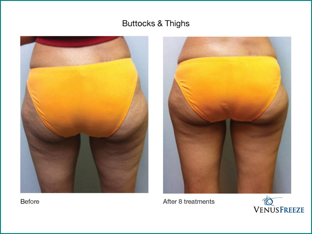 Body Contouring & Cellulite Reduction - done by our friendly staff at Celebrity Spa of Beaverton, Oregon 97007