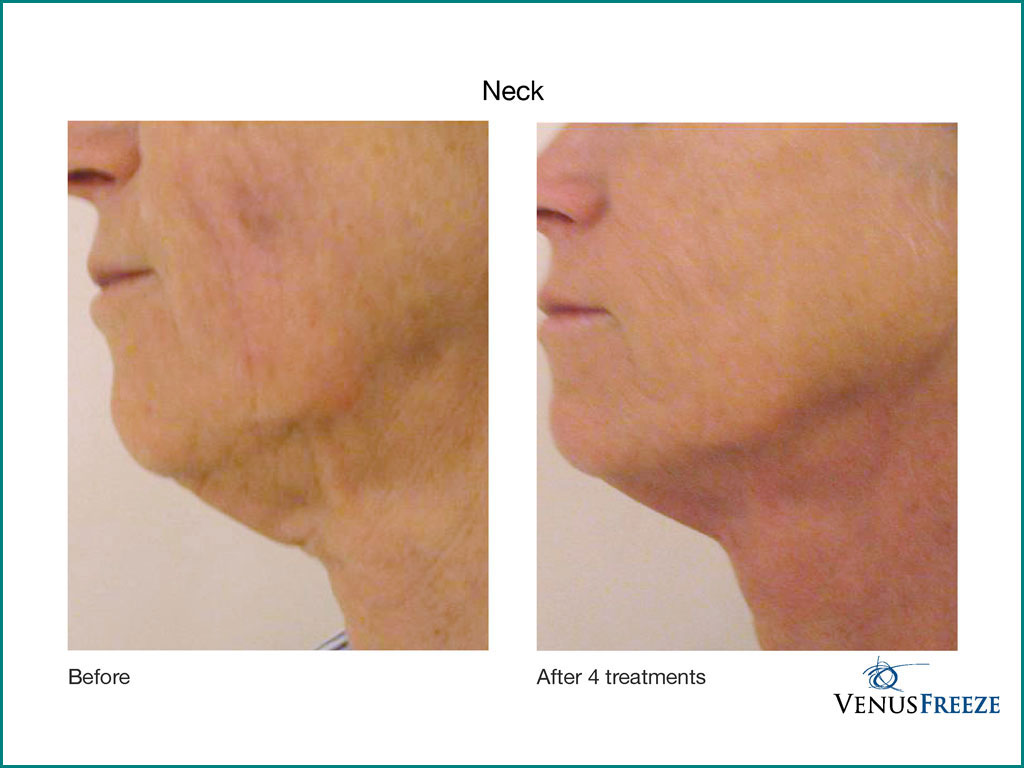 Wrinkle Reduction & Skin Tightening - done by our friendly staff at Celebrity Spa of Beaverton, Oregon 97007